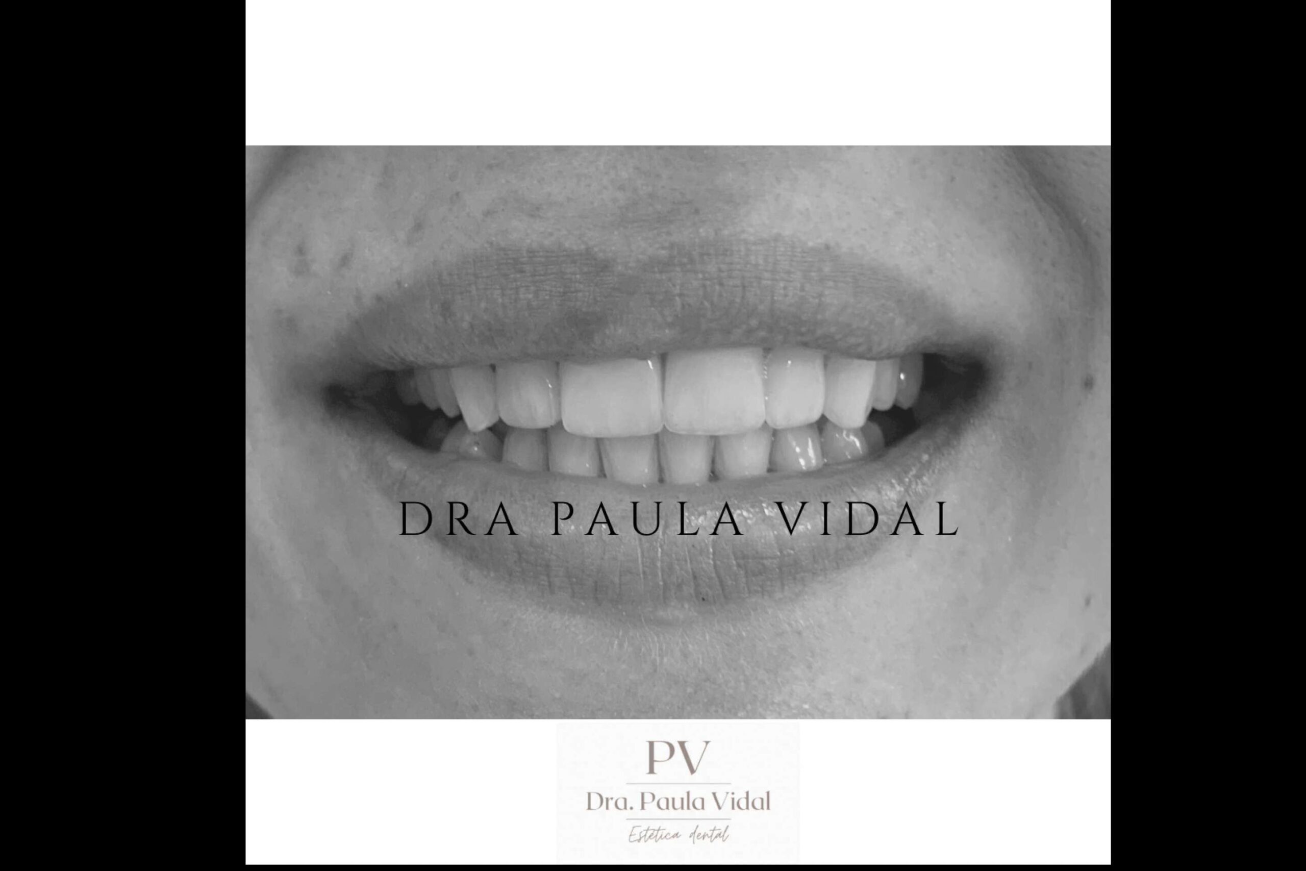En la Clínica Paula Vidal disponen de un servicio de carillas dentales