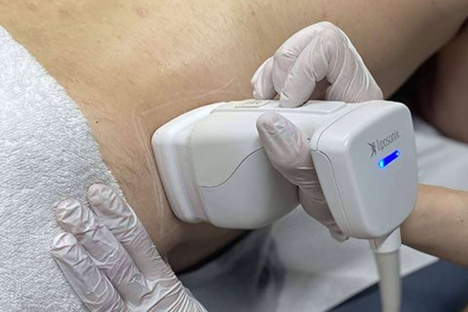 Liposonix es un tratamiento reductor sin dolor ni cirugía de la grasa localizada