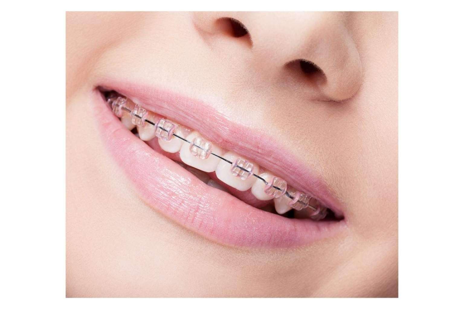 Los diferentes tipos de tratamiento de ortodoncia en Witizz