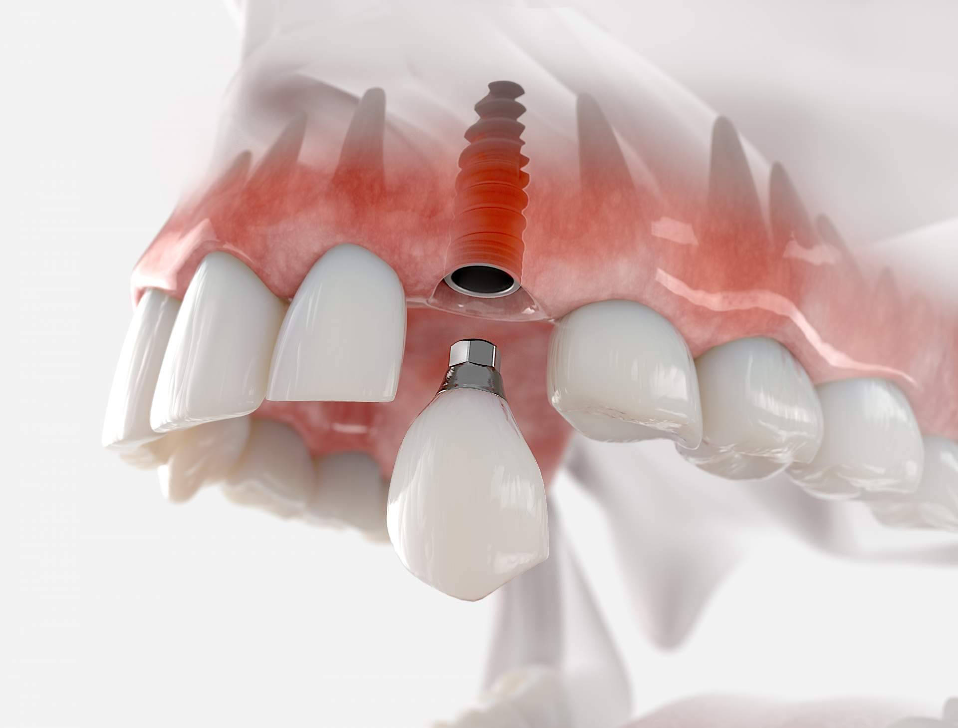 La técnica por la que apuesta Clínica Dental Sonrisas para conseguir una dentadura de 10 en sus pacientes, implantes postextracción con carga inmediata