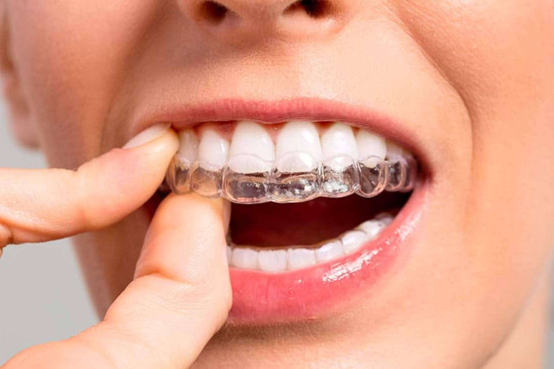 La Clínica Dental Ahoa ofrece la ortodoncia invisible con Invisalign®