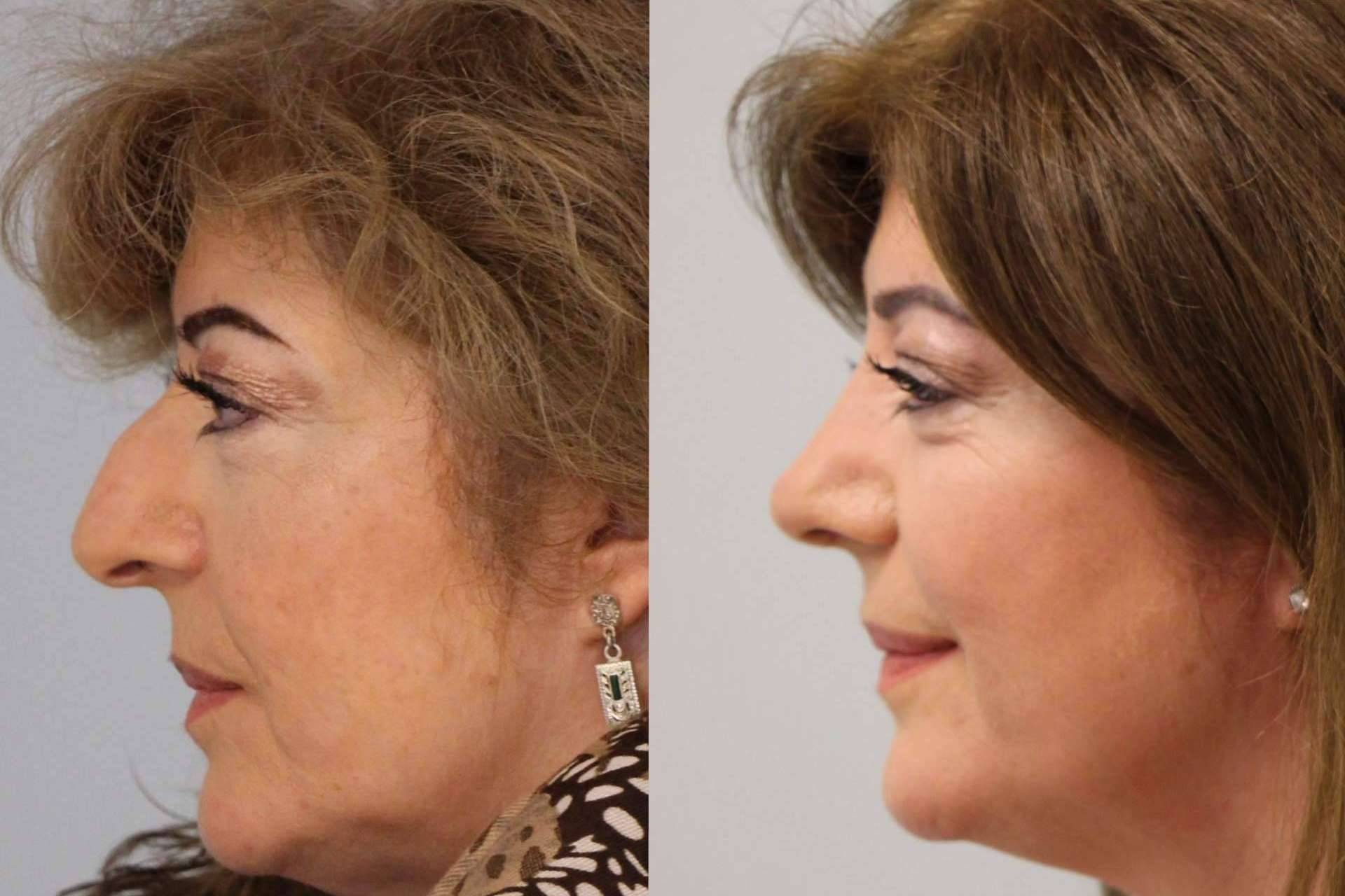 Qué hacer antes de pasar por una rinoplastia ultrasónica, por el Dr. Pérez Villar