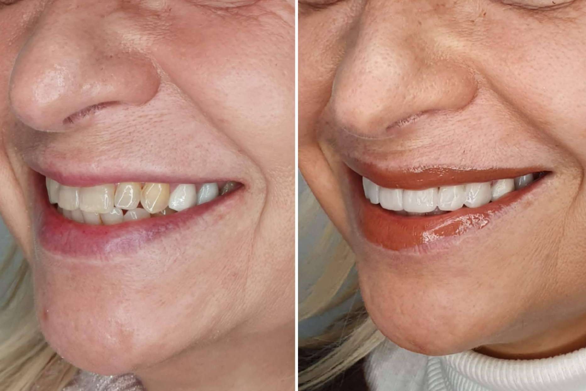 Dentinova ofrece alineación dentaria sin ortodoncia