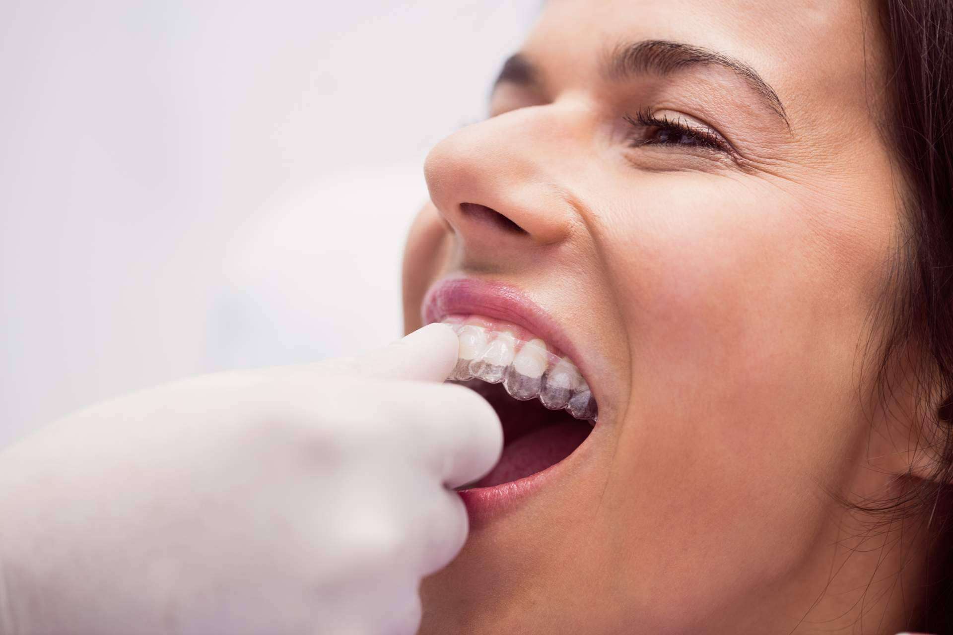 Toda la información sobre la ortodoncia para adultos, por Clínica Dental Delgado