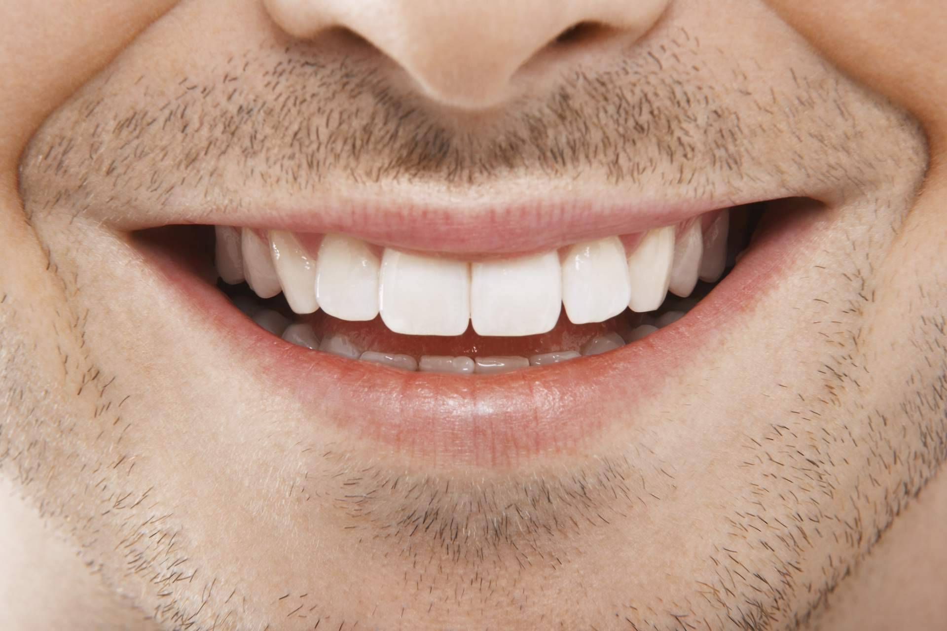 Carlos Saiz Smile explica qué son las carillas de composite