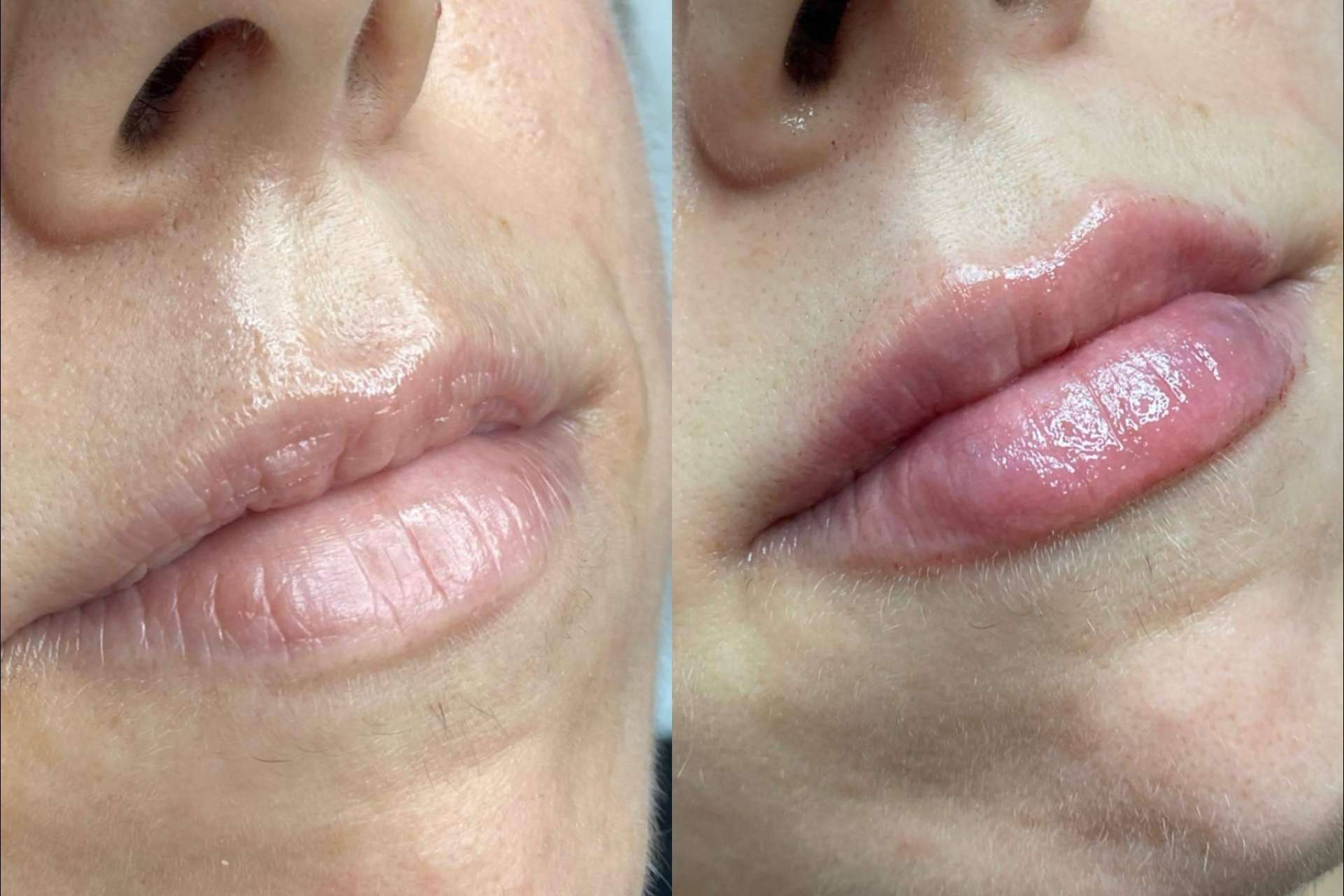 Conseguir unos labios 100 % naturales gracias a la técnica en dos pasos de la doctora Sandra Hermida