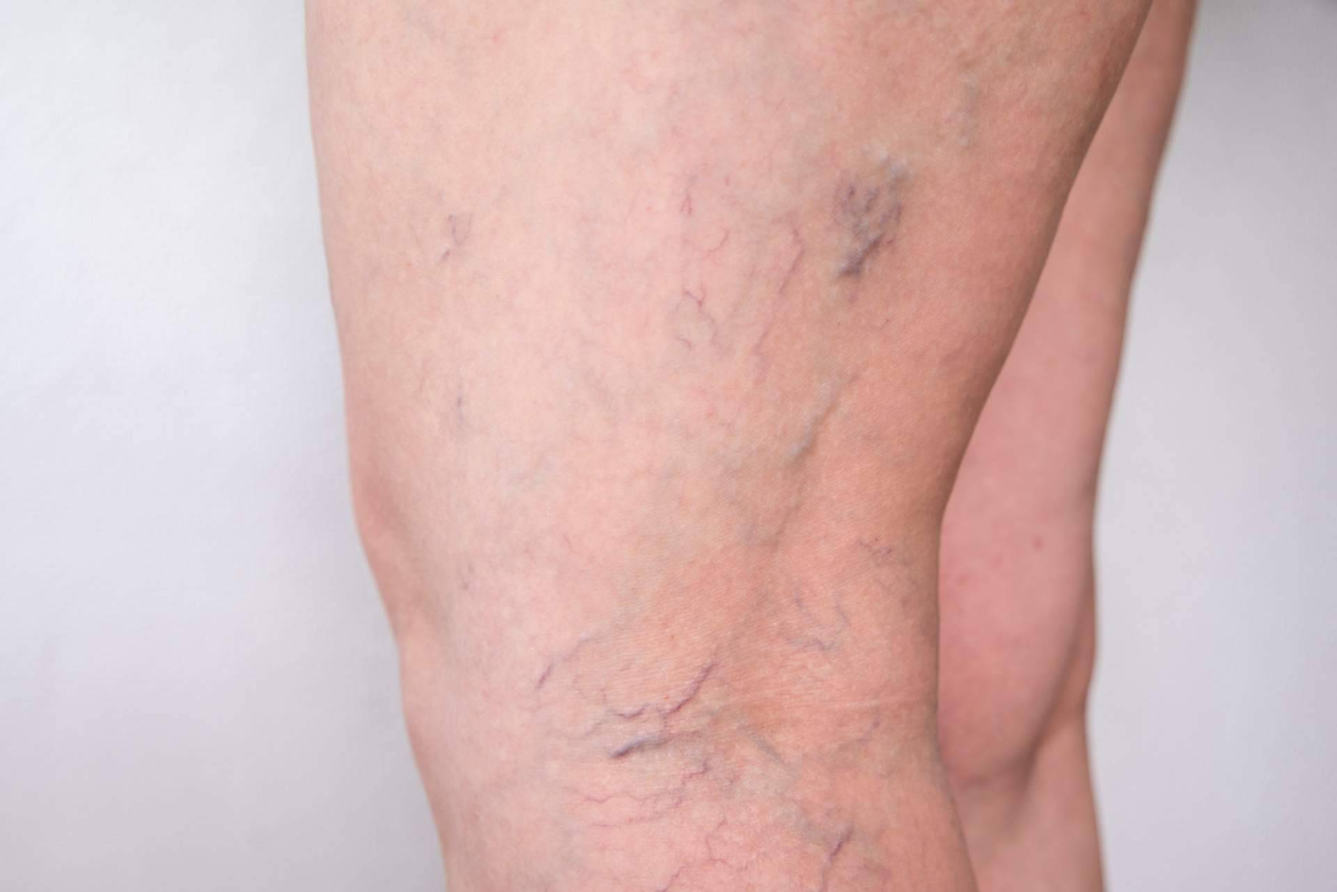 ¿Dónde encontrar especialistas en la eliminación de varices? Elegansse