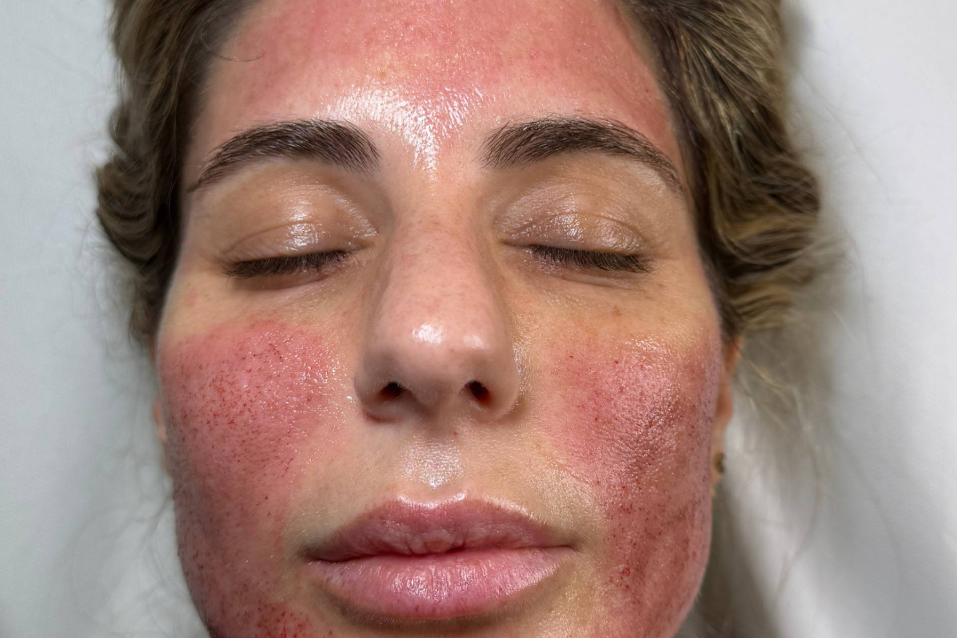 Qué es el vampiro facial y cómo actúa en la regeneración natural del rostro